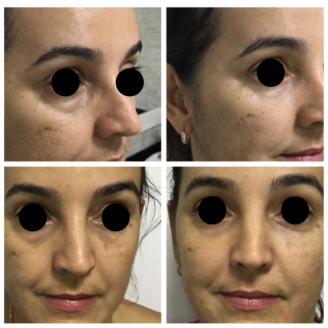 antes e depois 1