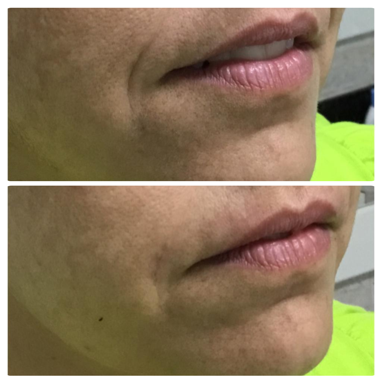 antes e depois